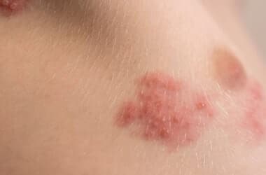 Shingles Shots Don’t Just Prevent Pain—They Might Save Your Life